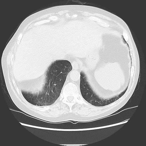 Bronchial stenosis - lung transplant (Radiopaedia 73133-83848 Axial lung window 51).jpg