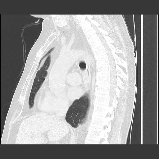 Bronchial stenosis - lung transplant (Radiopaedia 73133-83848 Sagittal lung window 35).jpg