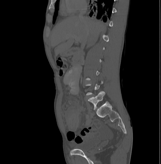 Bronchiectasis in Crohn disease (Radiopaedia 60311-67977 Sagittal bone window 89).jpg
