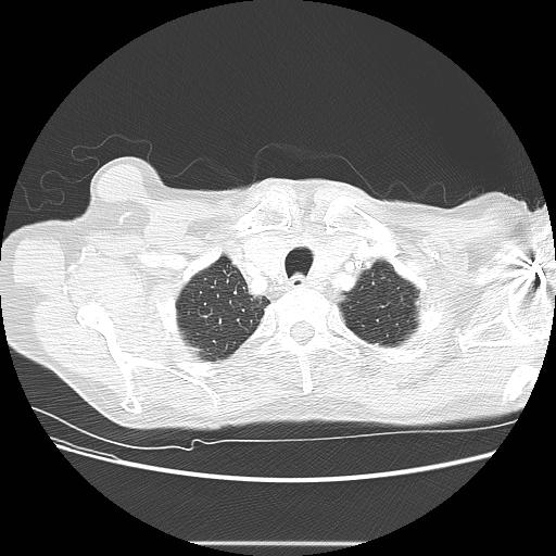 Bronchocele (Radiopaedia 17097-16795 Axial lung window 14).jpg