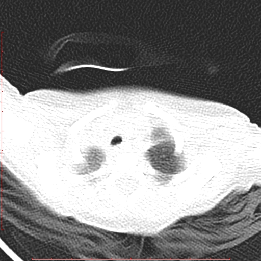 Bronchogenic cyst (Radiopaedia 78599-91409 Axial lung window 24).jpg