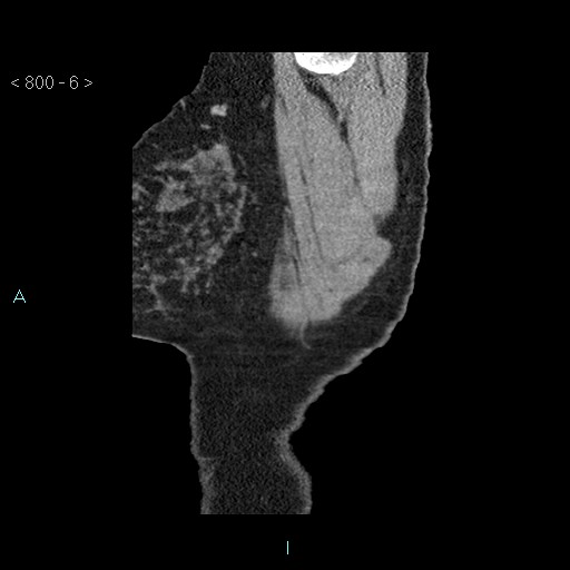 File:Bronchogenic cyst - posterior mediastinal (Radiopaedia 43885-47364 B 3).jpg