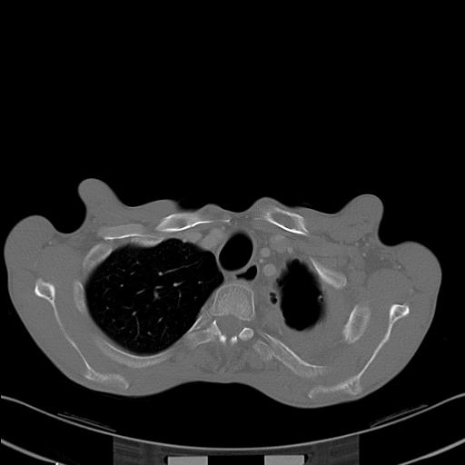 File:Bronchopleural fistula secondary to tuberculosis (Radiopaedia 20415-20322 Axial bone window 6).jpg