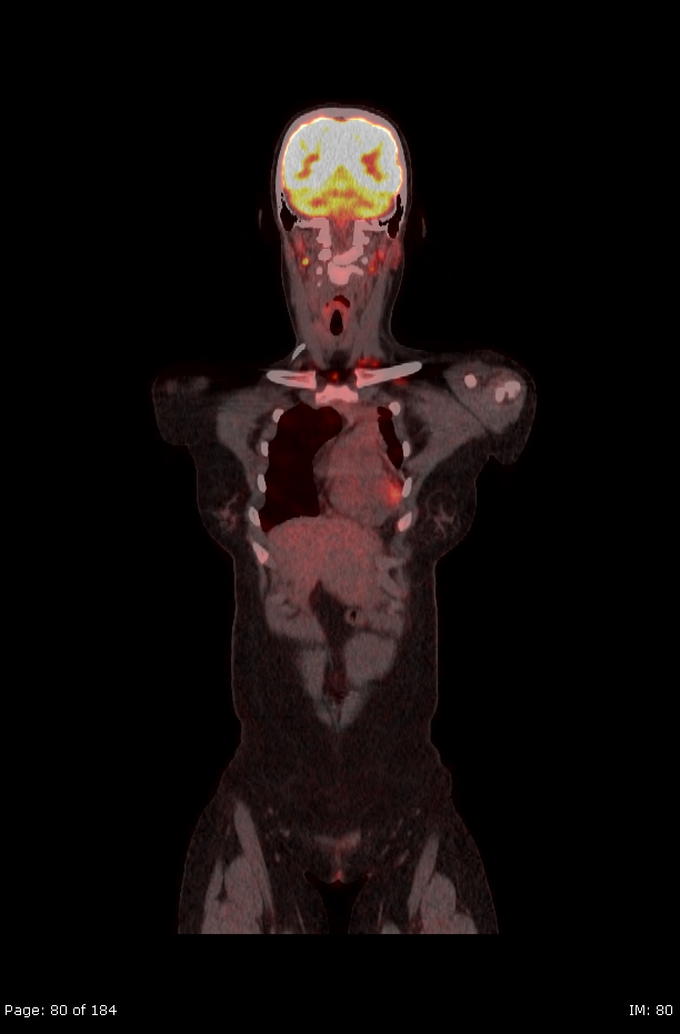 Brown fat uptake (FDG PET-CT) (Radiopaedia 77392-89513 Fused coronal 38).jpg