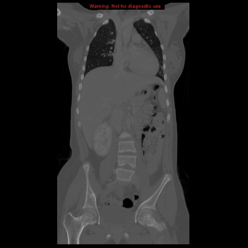 File:Brown tumor (Radiopaedia 12318-12596 D 32).jpg