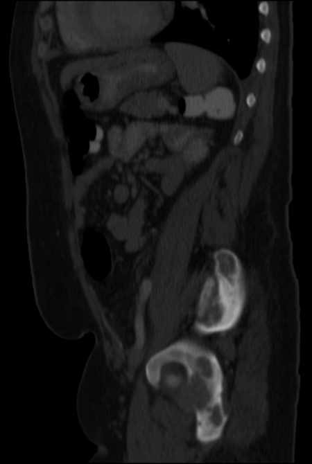 Brown tumors compressing the spinal cord (Radiopaedia 68442-77988 H 38).jpg