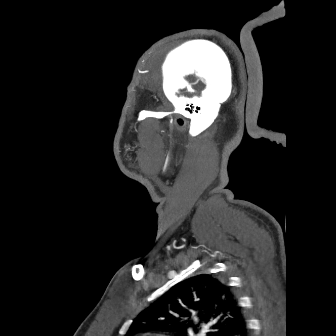 Buccal fat pad arteriovenous malformation (Radiopaedia 70936-81144 C 25).jpg