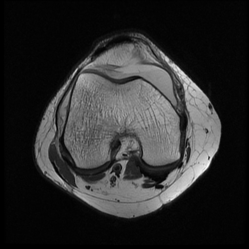 File:Bucket handle meniscus tear (Radiopaedia 56916-63751 Axial PD 8).jpg