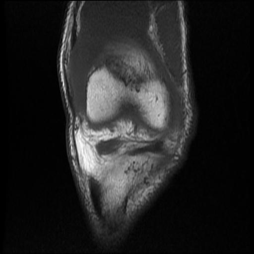File:Bucket handle tear - medial meniscus (Radiopaedia 69245-79026 Coronal T1 5).jpg