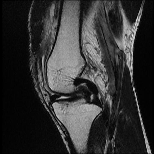 File:Bucket handle tear - medial meniscus (Radiopaedia 69245-79026 Sagittal T2 11).jpg