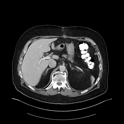 File:Buried bumper syndrome - gastrostomy tube (Radiopaedia 63843-72575 Axial 37).jpg