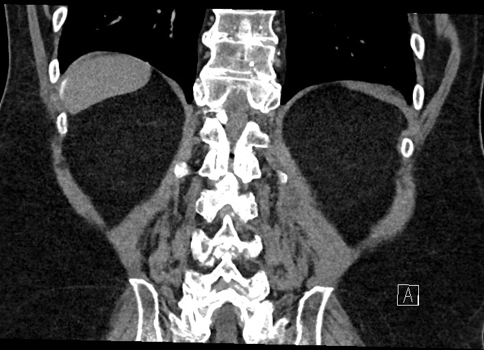 Buried bumper syndrome - gastrostomy tube (Radiopaedia 63843-72577 Coronal Inject 111).jpg