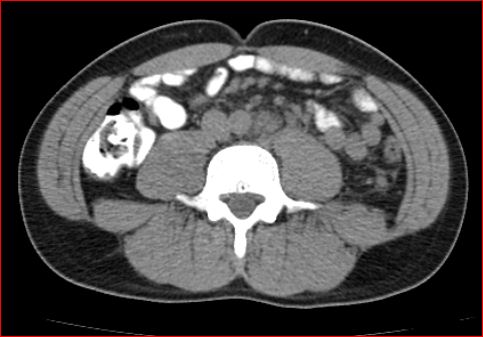 File:Burned-out testicular choriocarcinoma (Radiopaedia 32822-34040 Axial non-contrast 16).jpg