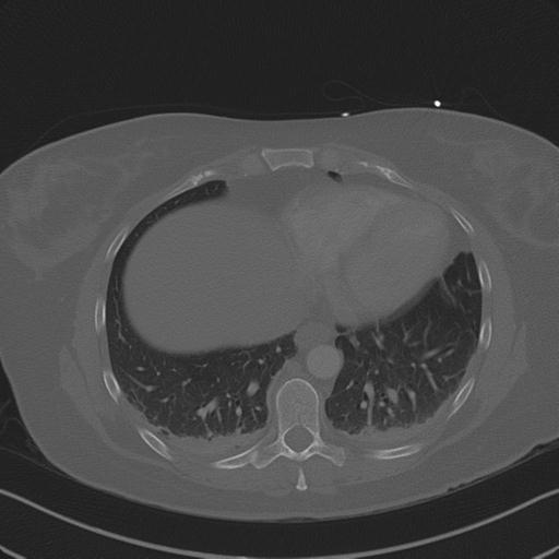Burst fracture - thoracic spine (Radiopaedia 30238-30865 Axial bone window 64).jpg