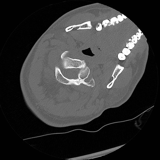 File:C1-C2 "subluxation" - normal cervical anatomy at maximum head rotation (Radiopaedia 42483-45607 Axial non-contrast 47).jpg