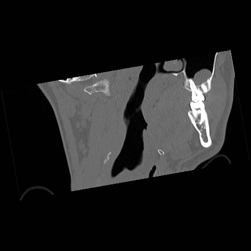 C1-C2 "subluxation" - normal cervical anatomy at maximum head rotation (Radiopaedia 42483-45607 Coronal non-contrast 2).jpg