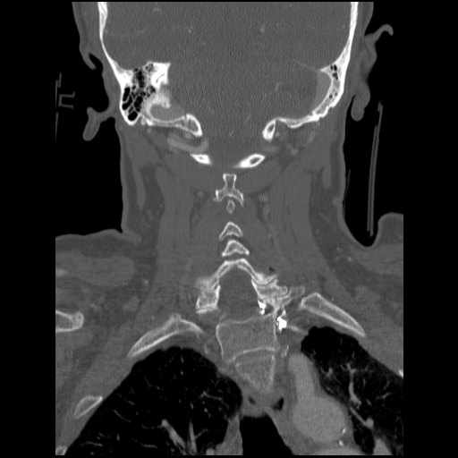 File:C1 anterior arch (plough) fracture - type 1 (Radiopaedia 76181-87720 Coronal bone window 37).jpg
