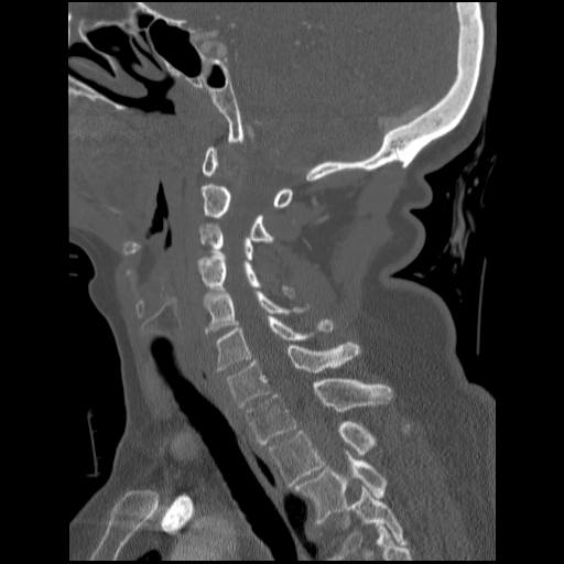 File:C1 anterior arch (plough) fracture - type 1 (Radiopaedia 76181-87720 Sagittal bone window 53).jpg