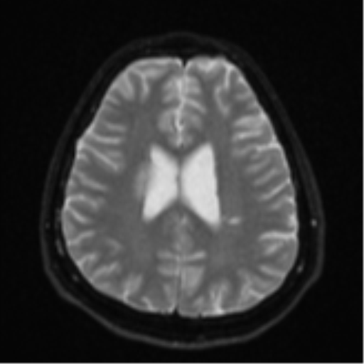 File:CNS vasculitis (Radiopaedia 55715-62263 Axial DWI 20).png
