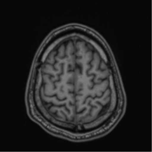 CNS vasculitis (Radiopaedia 55715-62263 Axial T1 83).png
