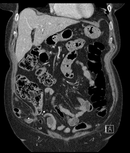 Calcified adrenal glands and Spigelian hernia (Radiopaedia 49741-54988 B 32).jpg