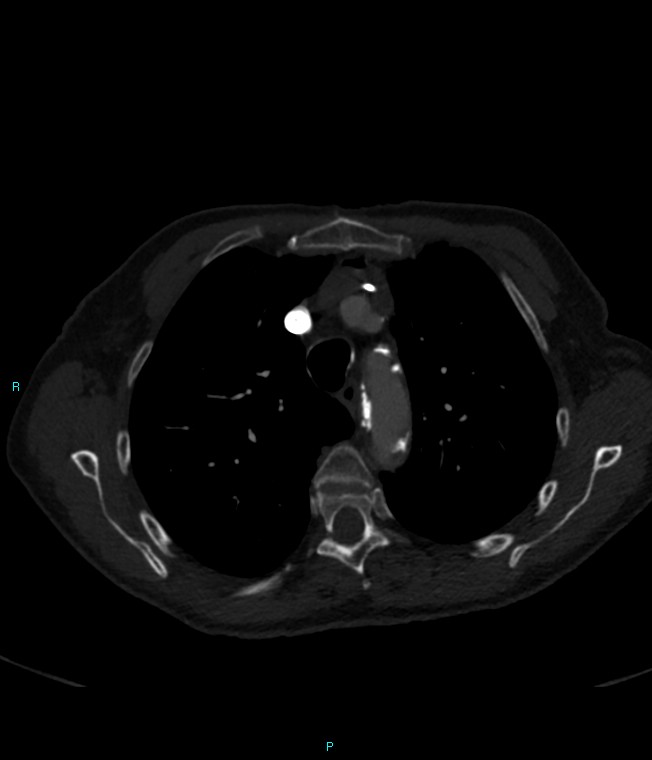 Calcified cerebral emboli from left ventricular thrombus (Radiopaedia 84420-99760 Axial bone window 21).jpg