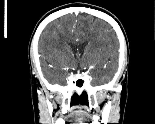 Calcified cerebral hydatid cyst (Radiopaedia 65603-74717 C 29).jpg
