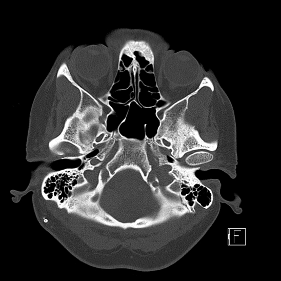 Calcified chronic subdural hematoma (Radiopaedia 77374-89492 Axial bone window 19).jpg