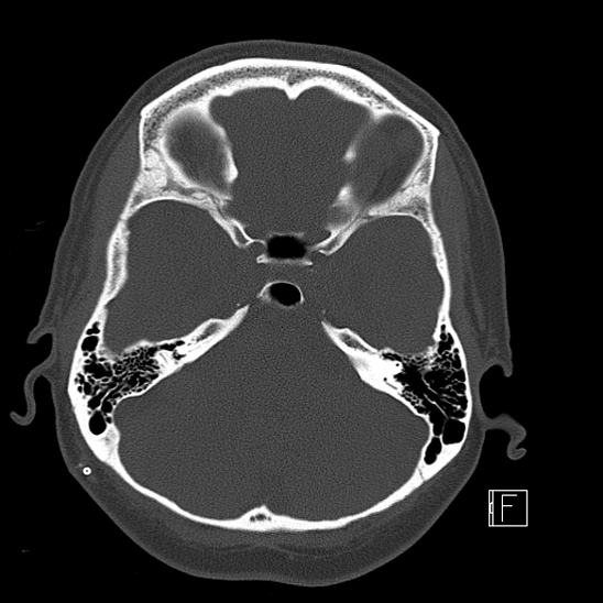 Calcified chronic subdural hematoma (Radiopaedia 77374-89492 Axial bone window 35).jpg