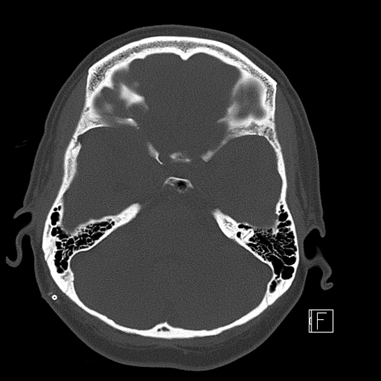 Calcified chronic subdural hematoma (Radiopaedia 77374-89492 Axial bone window 37).jpg