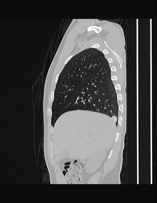 Calcifying pulmonary metastases (Radiopaedia 33359-34396 Sagittal lung window 56).jpg