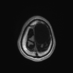 Callosal dysgenesis with interhemispheric cyst (Radiopaedia 53355-59335 Axial T1 143).jpg