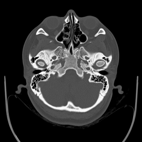 Calvarial osteoma (Radiopaedia 36520-38079 Axial bone window 21).jpg