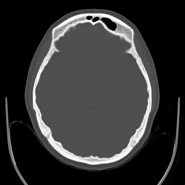 Calvarial osteoma (Radiopaedia 36520-38079 Axial bone window 44).jpg