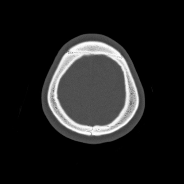 Calvarial osteoma (Radiopaedia 36520-38079 Axial bone window 96).jpg