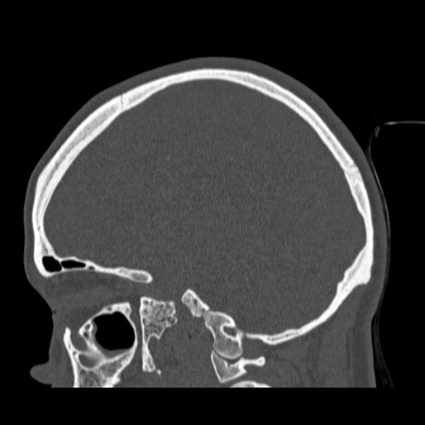 Calvarial osteoma (Radiopaedia 36520-38079 Sagittal bone window 45).jpg