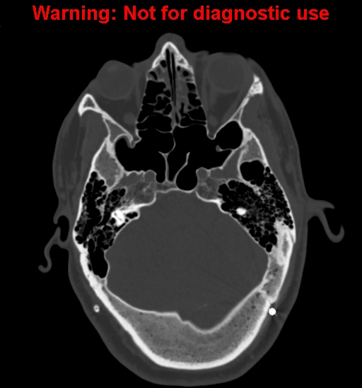 File:Calvarial thickening from chronic shunting (Radiopaedia 60079-67637 Axial bone window 48).jpg