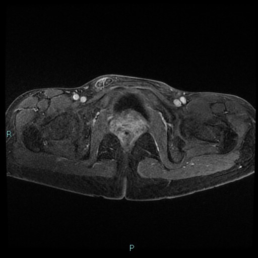 File:Canal of Nuck cyst (Radiopaedia 55074-61448 Axial T1 C+ fat sat 45).jpg