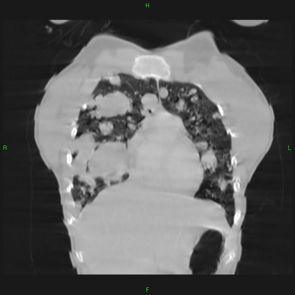 File:Cannon ball metastases - synovial sarcoma (Radiopaedia 26135-26271 Coronal lung window 1).jpg