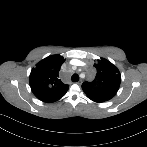 File:Cannonball metastases - testicular choriocarcinoma (Radiopaedia 84510-99891 B 37).jpg