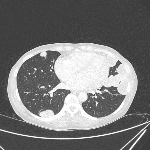 Canonball lung metastasis (Radiopaedia 77634-89837 Axial lung window 116).jpg