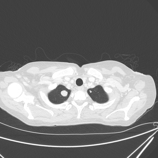 Canonball lung metastasis (Radiopaedia 77634-89837 Axial lung window 18).jpg