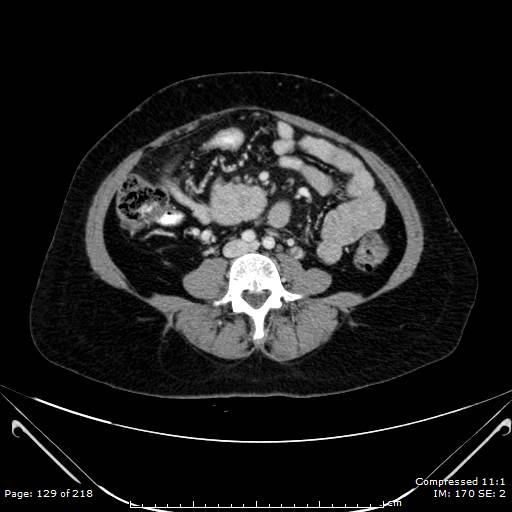 Carcinoid syndrome (Radiopaedia 52706-58626 A 65).jpg