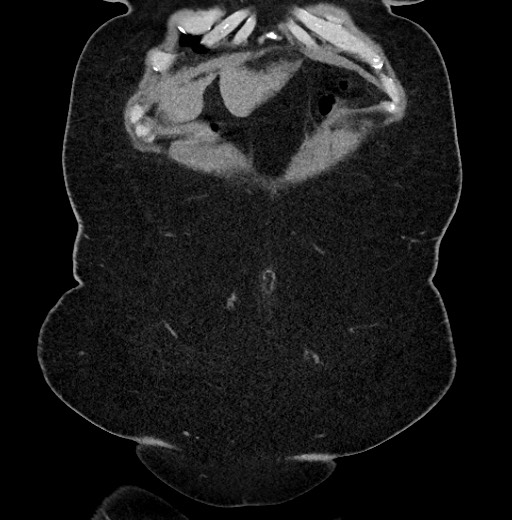 Carcinoid tumor - terminal ileum (Radiopaedia 60931-68740 Coronal non-contrast 7).jpg