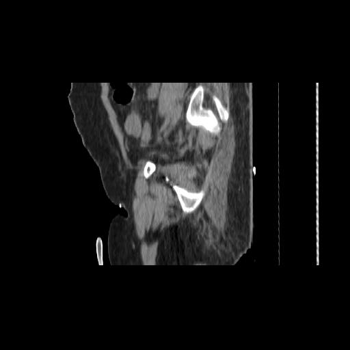 File:Carcinoma cervix- brachytherapy applicator (Radiopaedia 33135-34173 D 143).jpg