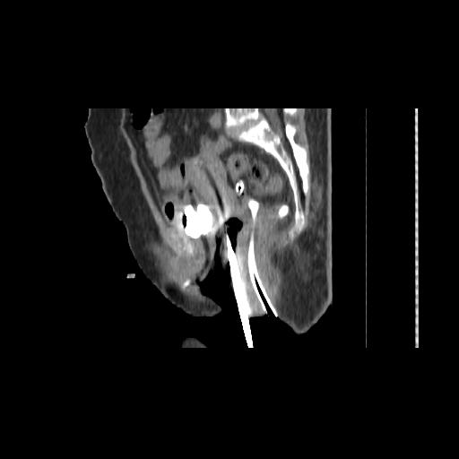 File:Carcinoma cervix- brachytherapy applicator (Radiopaedia 33135-34173 D 91).jpg