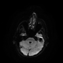 Carcinoma ex-pleomorphic adenoma of parotid (Radiopaedia 28383-28627 Ax DWI B-500 GE 64).jpg