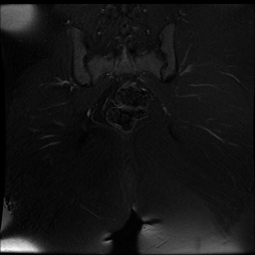 File:Carcinoma of the cervix (Radiopaedia 89018-105858 Coronal T2 fat sat 15).jpg
