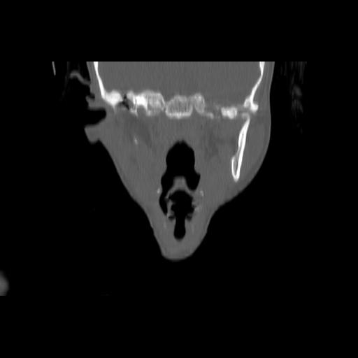 Carcinoma of the maxillary antrum (Radiopaedia 53805-59888 Coronal bone window 81).jpg