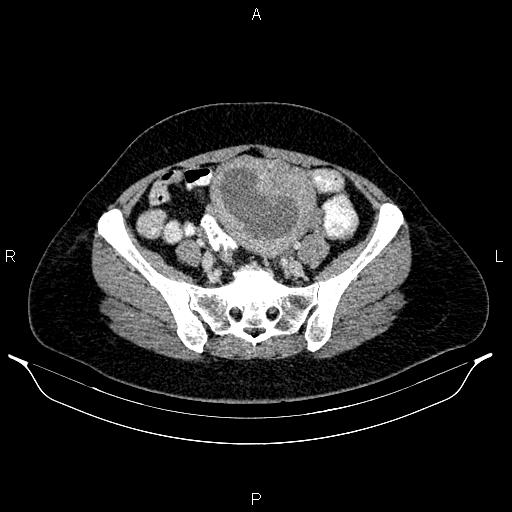 Carcinoma of uterine cervix (Radiopaedia 85861-101700 A 63).jpg